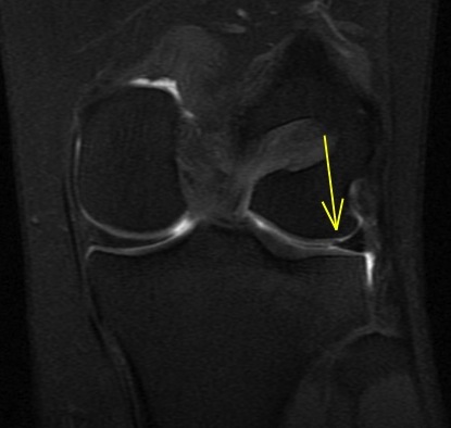 Figure 4 for case Lateral meniscus flap tear and adjacent stress fracture